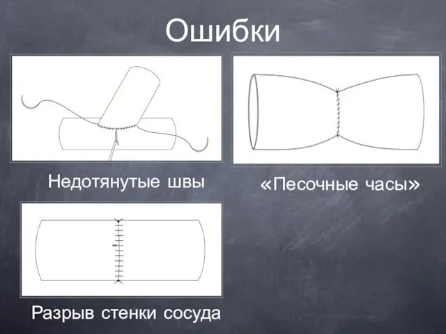 Ошибки Недотянутые швы «Песочные часы» Разрыв стенки сосуда