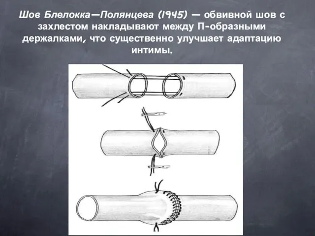 Шов Блелокка—Полянцева (1945) — обвивной шов с захлестом накладывают между П-образными