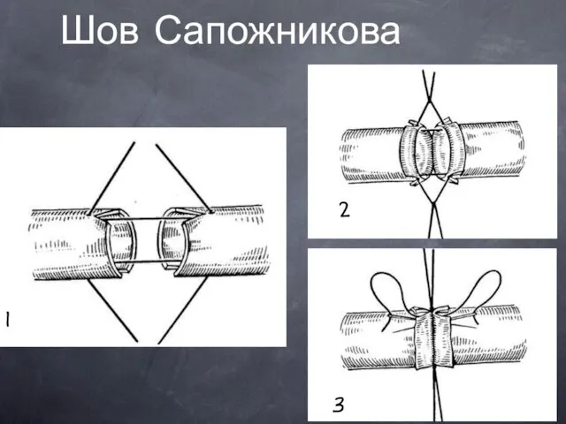 Шов Сапожникова 1 2 3