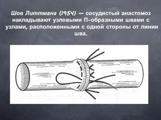 Шов Литтмана (1954) — сосудистый анастомоз накладывают узловыми П-образными швами с