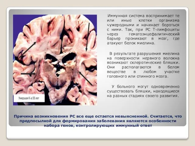 Причина возникновения РС все еще остается невыясненной. Считается, что предпосылкой для