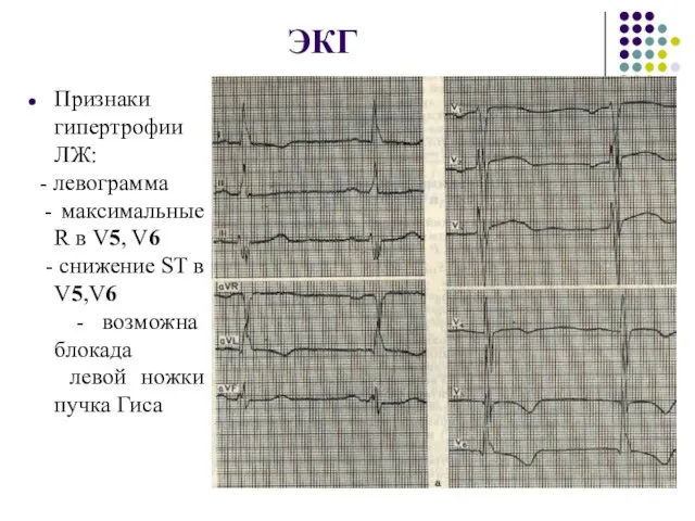 ЭКГ Признаки гипертрофии ЛЖ: - левограмма - максимальные R в V5,
