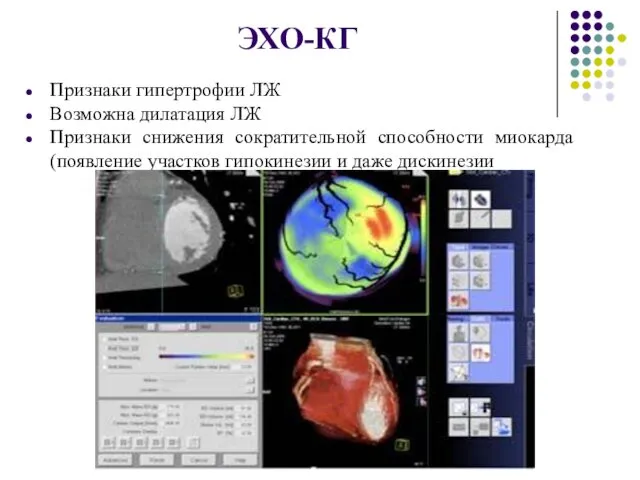 ЭХО-КГ Признаки гипертрофии ЛЖ Возможна дилатация ЛЖ Признаки снижения сократительной способности