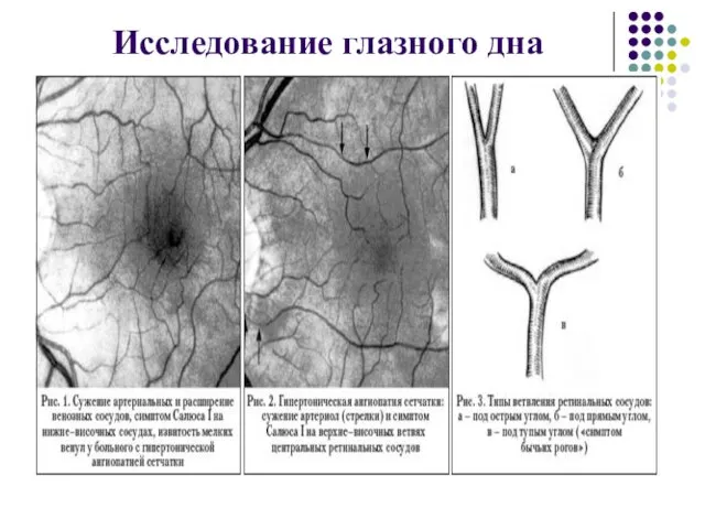 Исследование глазного дна