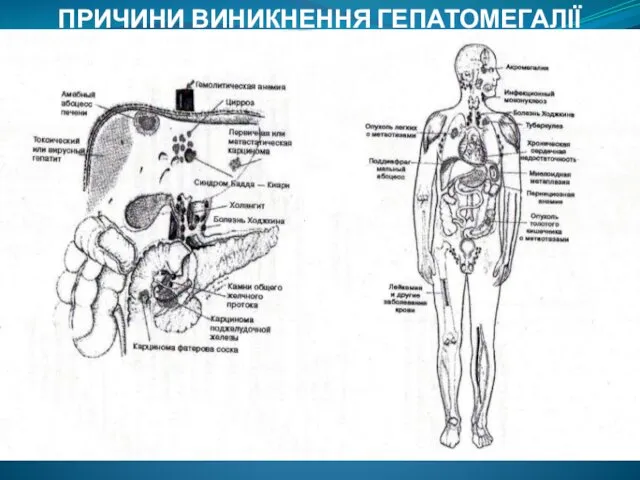 ПРИЧИНИ ВИНИКНЕННЯ ГЕПАТОМЕГАЛІЇ