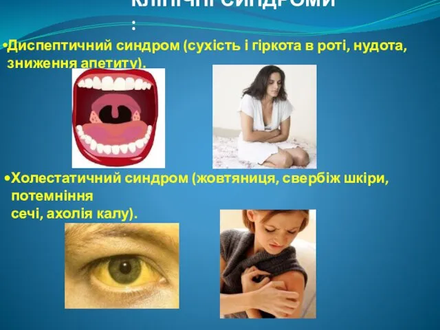 КЛІНІЧНІ СИНДРОМИ : Диспептичний синдром (сухість і гіркота в роті, нудота,