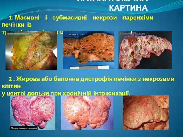 ПАТАНАТОМІЧНА КАРТИНА 1. Масивні і субмасивні некрози паренхіми печінки із трансформацією