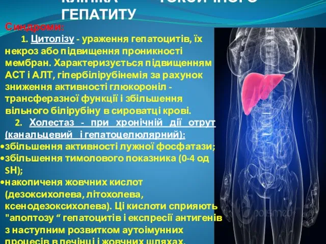 КЛІНІКА ТОКСИЧНОГО ГЕПАТИТУ Синдроми: 1. Цитолізу - ураження гепатоцитів, їх некроз