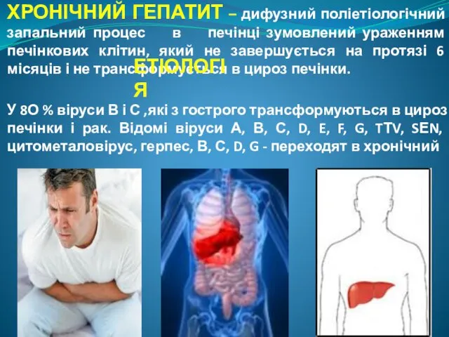 ХРОНІЧНИЙ ГЕПАТИТ – дифузний поліетіологічний запальний процес в печінці зумовлений ураженням