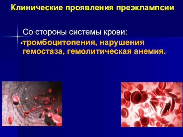 Клинические проявления преэклампсии Со стороны системы крови: тромбоцитопения, нарушения гемостаза, гемолитическая анемия.