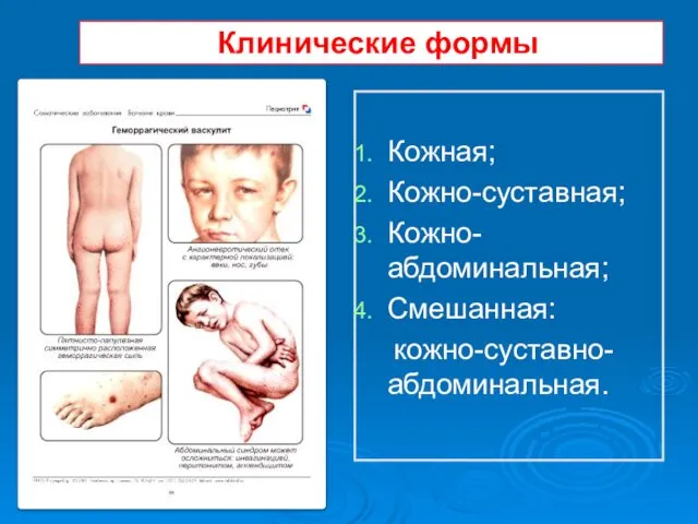 Клинические формы Кожная; Кожно-суставная; Кожно-абдоминальная; Смешанная: кожно-суставно-абдоминальная.