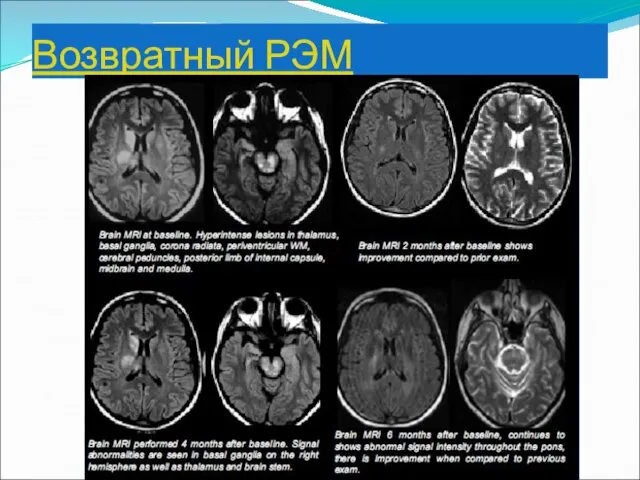 Возвратный РЭМ