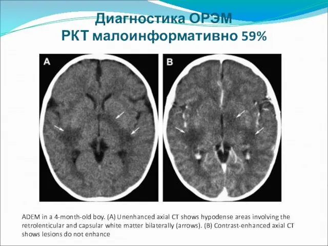 Диагностика ОРЭМ РКТ малоинформативно 59% ADEM in a 4-month-old boy. (A)