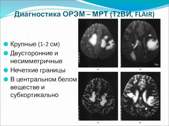 Диагностика ОРЭМ – МРТ (Т2ВИ, FLAIR) Крупные (1-2 см) Двусторонние и