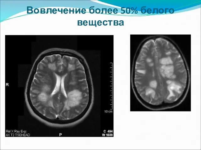 Вовлечение более 50% белого вещества