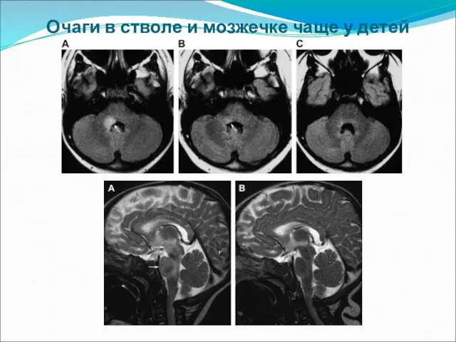 Очаги в стволе и мозжечке чаще у детей