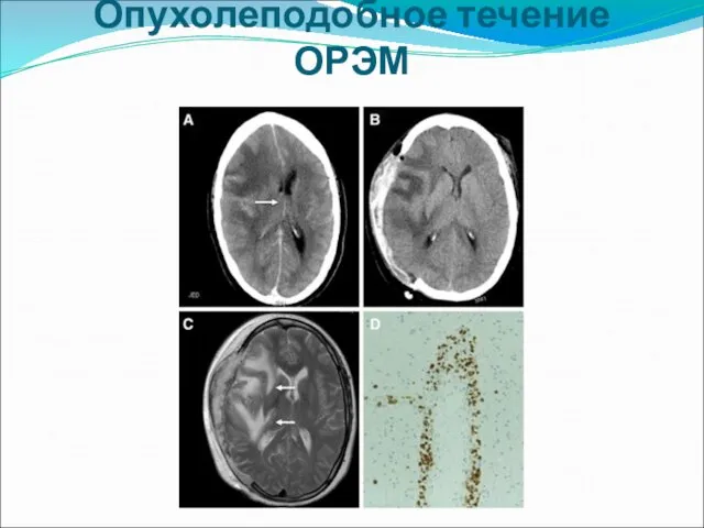 Опухолеподобное течение ОРЭМ