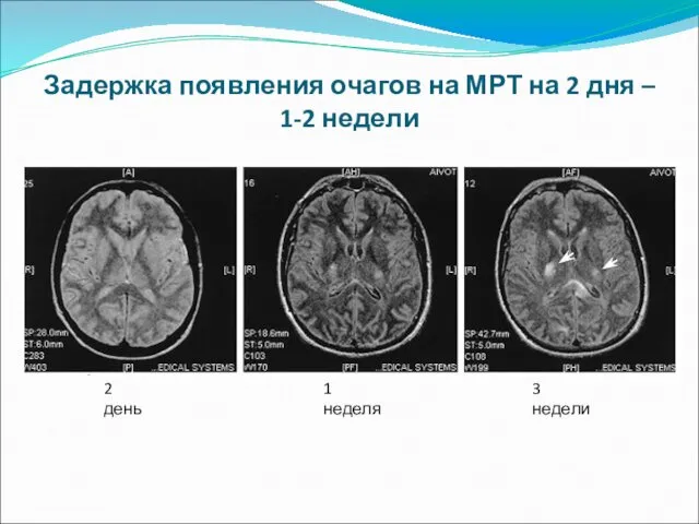 Задержка появления очагов на МРТ на 2 дня – 1-2 недели