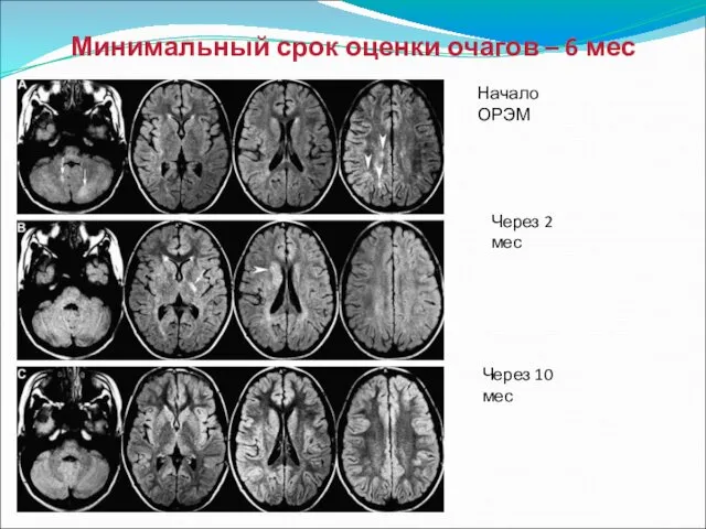 Начало ОРЭМ Через 2 мес Через 10 мес Минимальный срок оценки очагов – 6 мес