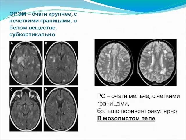 ОРЭМ – очаги крупнее, с нечеткими границами, в белом веществе, субкортикально