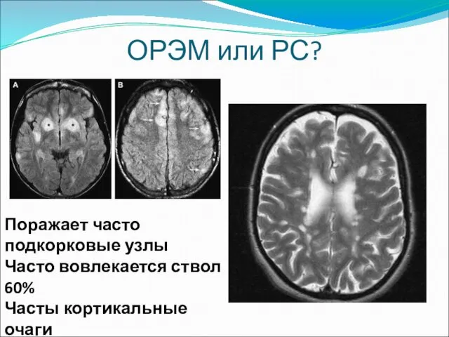 ОРЭМ или РС? Поражает часто подкорковые узлы Часто вовлекается ствол 60% Часты кортикальные очаги