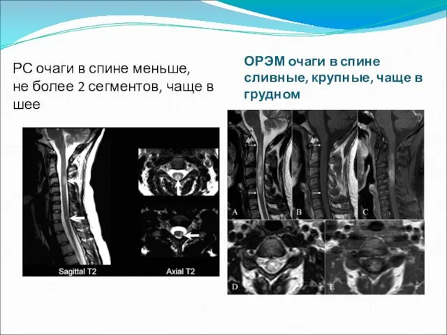 ОРЭМ очаги в спине сливные, крупные, чаще в грудном РС очаги