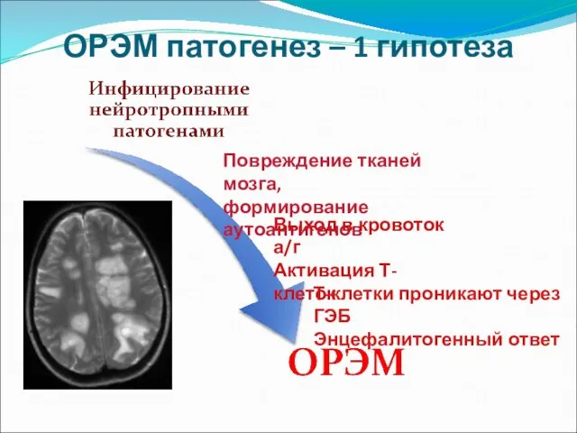 ОРЭМ патогенез – 1 гипотеза Повреждение тканей мозга, формирование аутоантигенов Выход