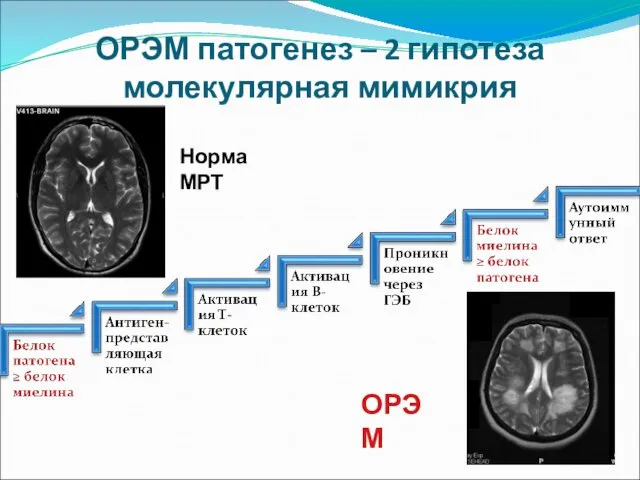 ОРЭМ патогенез – 2 гипотеза молекулярная мимикрия Норма МРТ ОРЭМ