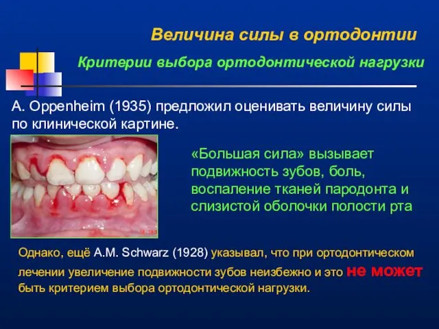 Величина силы в ортодонтии Критерии выбора ортодонтической нагрузки A. Oppenheim (1935)