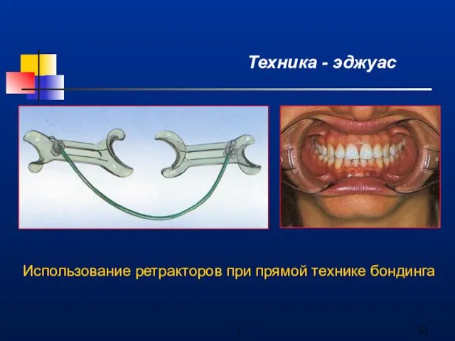 1 Техника - эджуас Использование ретракторов при прямой технике бондинга