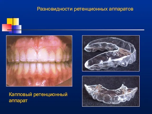 Разновидности ретенционных аппаратов Капповый ретенционный аппарат