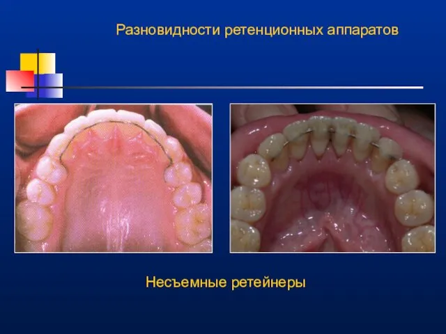 Разновидности ретенционных аппаратов Несъемные ретейнеры