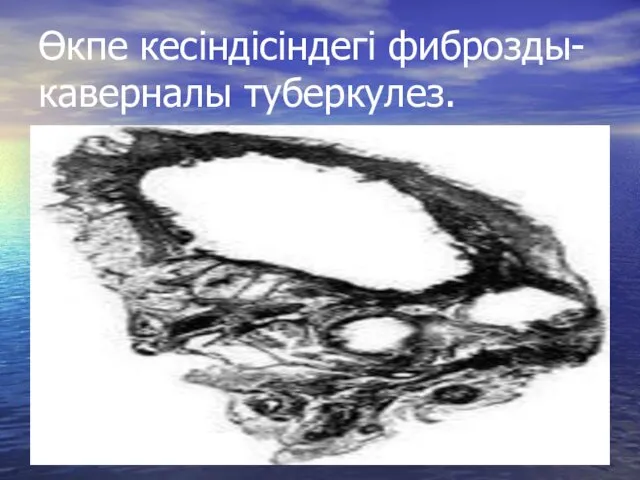 Өкпе кесіндісіндегі фиброзды-каверналы туберкулез.