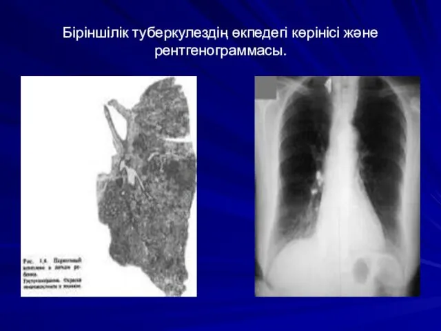 Біріншілік туберкулездің өкпедегі көрінісі және рентгенограммасы.