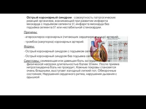 Острый коронарный синдром - совокупность патологических реакций организма, возникающий при развитии