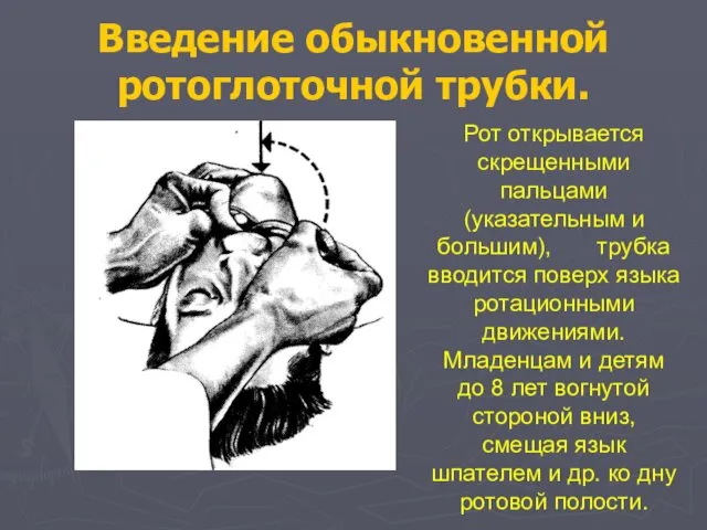 Введение обыкновенной ротоглоточной трубки. Рот открывается скрещенными пальцами (указательным и большим),