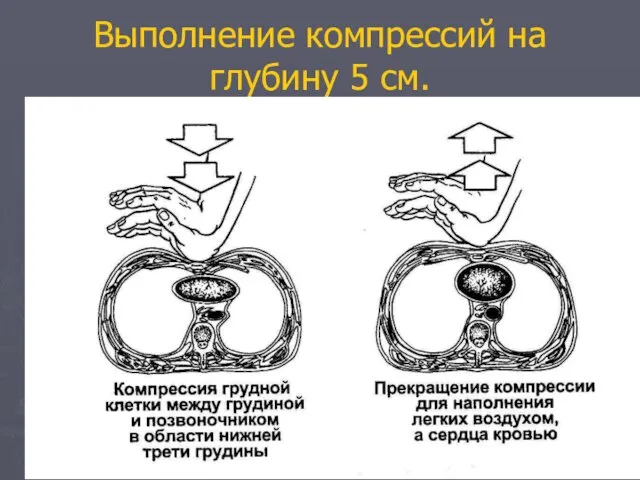 Выполнение компрессий на глубину 5 см.