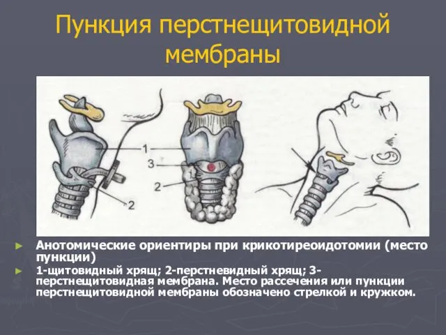 Пункция перстнещитовидной мембраны Анотомические ориентиры при крикотиреоидотомии (место пункции) 1-щитовидный хрящ;