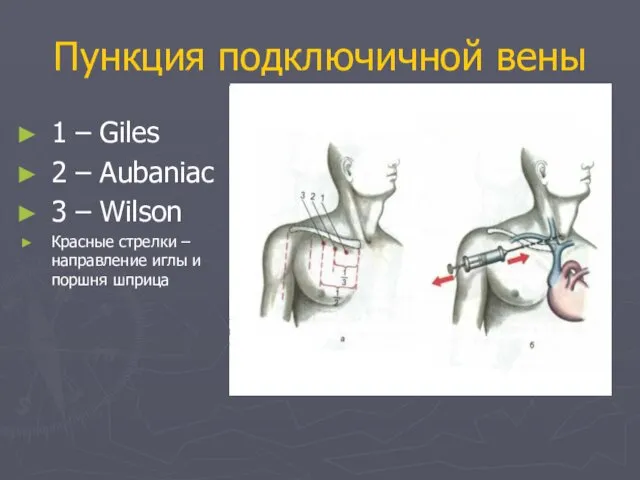 Пункция подключичной вены 1 – Giles 2 – Aubaniac 3 –