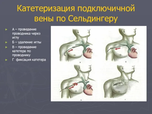 Катетеризация подключичной вены по Сельдингеру А – проведение проводника через иглу