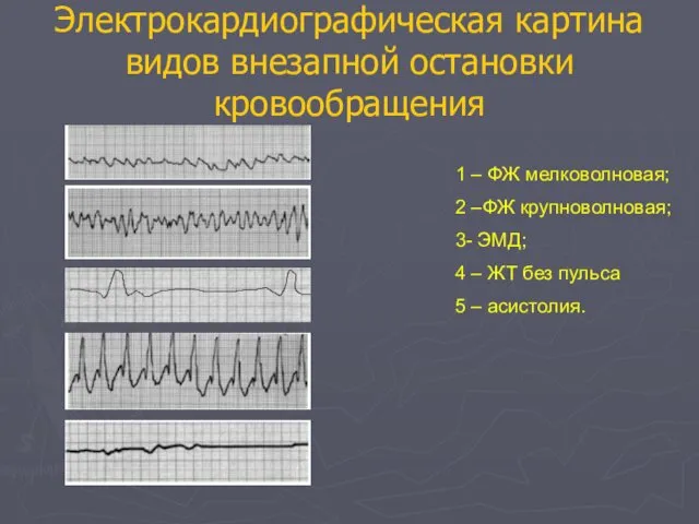 Электрокардиографическая картина видов внезапной остановки кровообращения 1 – ФЖ мелковолновая; 2