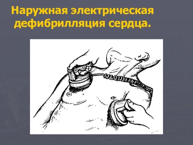 Наружная электрическая дефибрилляция сердца.