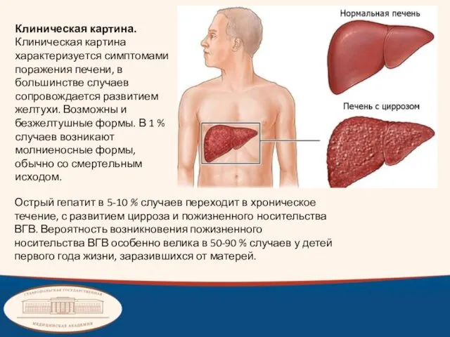 Клиническая картина. Клиническая картина характеризуется симптомами поражения печени, в большинстве случаев