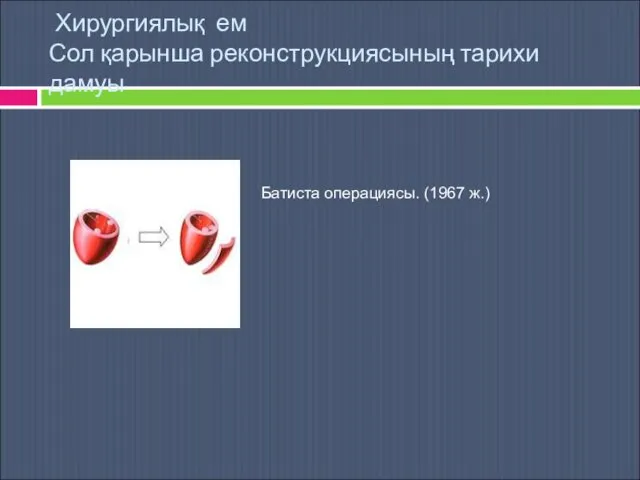 Хирургиялық ем Сол қарынша реконструкциясының тарихи дамуы Батиста операциясы. (1967 ж.)