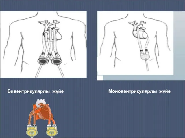 Бивентрикулярлы жүйе Моновентрикулярлы жүйе