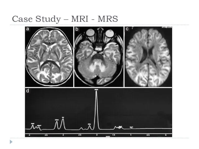 Case Study – MRI - MRS