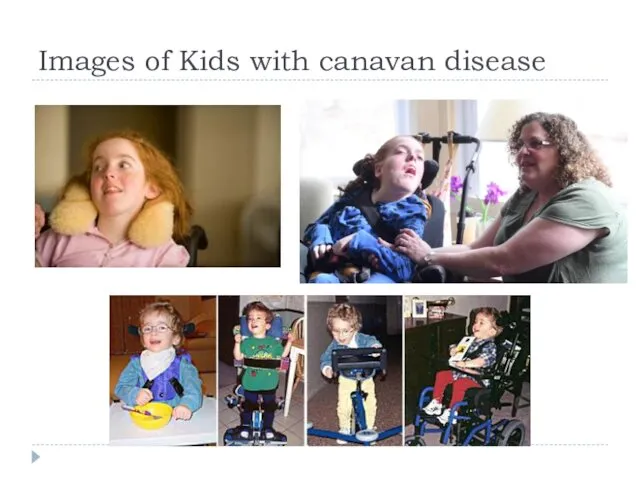Images of Kids with canavan disease