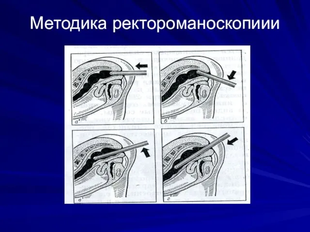 Методика ректороманоскопиии