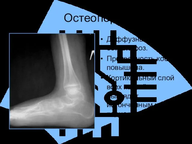 Остеопороз Диффузный остеопороз. Прозрачность кости повышена. Кортикальный слой всех костей выглядит истонченным и подчеркнутым