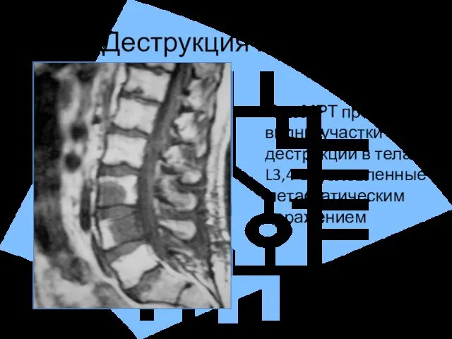 Деструкция на МРТ При МРТ прекрасно видны участки деструкции в телах L3,4 обусловленные метастатическим поражением